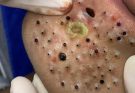 Cyst vs Blackhead Extreme Close-Up Acne Removal